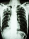 Mycobacterium Tuberculosis Infection (pulmonary Tuberculosis) Stock Photo