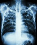 Pulmonary Tuberculosis Stock Photo