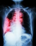 Lung Cancer .  Film Chest X-ray Show Right Lung Mass , Wide Mediastinum , Pneumonia And Right Pleural Effusion Stock Photo