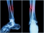 Fracture Shaft Of Fibula Bone ( Leg Bone ) .  X-ray Of Leg ( 2 Position : Side And Front View ) Stock Photo