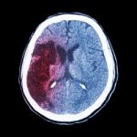 Ct Brain : Show Ischemic Stroke (hypodensity At Right Frontal-pa Stock Photo