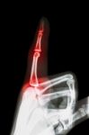 Rheumatoid Arthritis , Gouty Arthritis ( Film X-ray Index Finger And Hand ( Point A Finger ) And Inflame At Finger ) Stock Photo