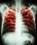 Pulmonary Tuberculosis Stock Photo