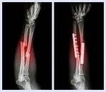 Fracture Both Bone Of Forearm. It Was Operated And Internal Fixed With Plate And Screw (left Image : Before Operation , Right Image : After Operation) Stock Photo