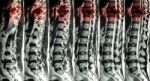 Mri Of Lumbar & Thoracic Spine : Show Fracture Of Thoracic Spine And Compress Spinal Cord ( Myelopathy ) Stock Photo