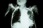 Pulmonary Tuberculosis With Acute Respiratory Failure ( Film Chest X-ray Of Old Patient Show Alveolar And Interstitial Infiltration Both Lung With Endotracheal Tube ) Due To Mycobacterium Tuberculosis Stock Photo