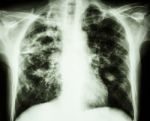 Pulmonary Tuberculosis Stock Photo