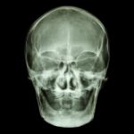 Normal Old Aged Asian Skull (thai People),(no Tooth) Stock Photo