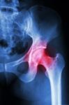 X-ray Left Hip And Arthritis Left Hip Stock Photo