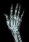 Multiple Fracture At Index,little Finger,metacarpal Bone Stock Photo