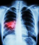 Pneumonia ( Film Chest X-ray Show Alveolar Infiltrate At Right Middle Lung ) ( Image For Pulmonary Tuberculosis , Mers-cov , Sars ) Stock Photo