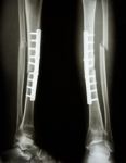 Fracture Shaft Of Tibia And Fibula Stock Photo