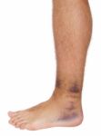 Ankle Sprain Stock Photo