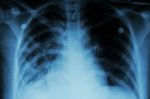 Pulmonary Tuberculosis ( Tb )  :  Chest X-ray Show Alveolar Infiltration At Both Lung Due To Mycobacterium Tuberculosis Infection Stock Photo