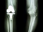 Film X-ray Knee Of Osteoarthritis Knee Patient And Artificial Joint Stock Photo