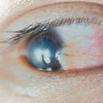 Pterygium Stock Photo