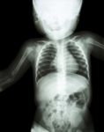 Film X-ray Child 's Body ( Normal Baby ) Stock Photo