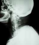 Cervical Spondylosis .  Film X-ray Of Cervical Spine ( Lateral Position ) ( Side View ) Stock Photo