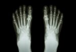 Film X-ray Both Foot ( Front View ) Stock Photo