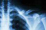 Fracture Left Clavicle Stock Photo