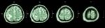 Brain Tumor  ( Film Ct-scan Of Brain : Show Part Of Brain With Tumor ) Stock Photo