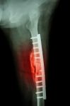 Fracture Shaft Of Femur. It Was Operated And Internal Fixation B Stock Photo