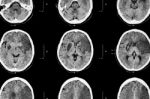 Ischemic Stroke : ( Ct Of Brain Show Cerebral Infarction At Left Frontal - Temporal - Parietal Lobe ) ( Nervous System Background ) Stock Photo