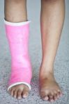 Ankle Sprain Stock Photo