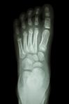 X-ray Foot Ap : Show Normal Child's Foot Stock Photo