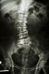 Scoliosis Stock Photo