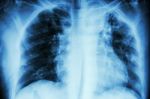 Pulmonary Tuberculosis .  Chest X-ray : Interstitial Infiltratio Stock Photo