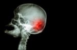 X-ray Skull Open Mouth ( Side View ) And Stroke ( Cerebrovascular Accident ( Cva ) ) And Blank Area At Right Side Stock Photo