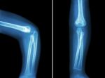 Film X-ray Of Child 's Elbow ( Normal Child 's Elbow ) ( Side And Front View , Lateral And Anterior - Posterior View ) ( 2 Position ) Stock Photo