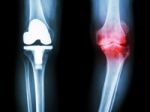 Film X-ray Knee Of Osteoarthritis Knee Patient And Artificial Joint Stock Photo