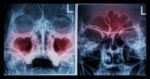 Film X-ray Paranasal Sinus : Show Sinusitis At Maxillary Sinus ( Left Image ) , Frontal Sinus ( Right Image ) Stock Photo