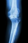 Osteoarthritis Knee Patient Stock Photo