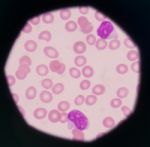 Blast Cells In Peripheral Blood Images Stock Photo