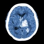 Ct Brain : Show Left Thalamic Hemorrhage (hemorrhagic Stroke) Stock Photo