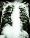 Pulmonary Tuberculosis Stock Photo