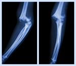 Fracture Elbow (left Image : Side Position , Right Image : Front Position) Stock Photo