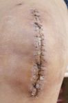 Knee Replacement Incision Stock Photo