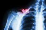 Fracture Right Clavicle Stock Photo