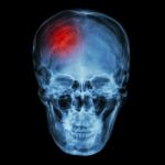 X-ray Asian Skull (thai People) And Headache Stock Photo