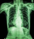 Chest X-ray Of Old Patient ( Calcification At Rib , Trachea , Bronchus ) Stock Photo