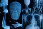 Collection Of  X-ray , Multiple Part Of Adult  Show Fracture Bone And  Disease Stock Photo