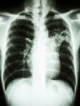 Mycobacterium Tuberculosis Infection (pulmonary Tuberculosis) Stock Photo