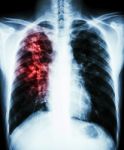 Pulmonary Tuberculosis Stock Photo