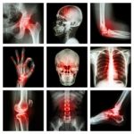 Collection X-ray And Multiple Injury Stock Photo