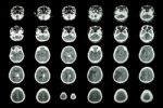 Hemorrhagic Stroke And Ischemic Stroke .  Ct Scan Of Brain : Intracerebral Hemorrhage ( 3 Left Column , Cerebral Infarction ( 3 Right Column )) ( Medical And Science Background ) Stock Photo