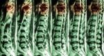 Mri Of Lumbar & Thoracic Spine : Show Fracture Of Thoracic Spine And Compress Spinal Cord ( Myelopathy ) Stock Photo